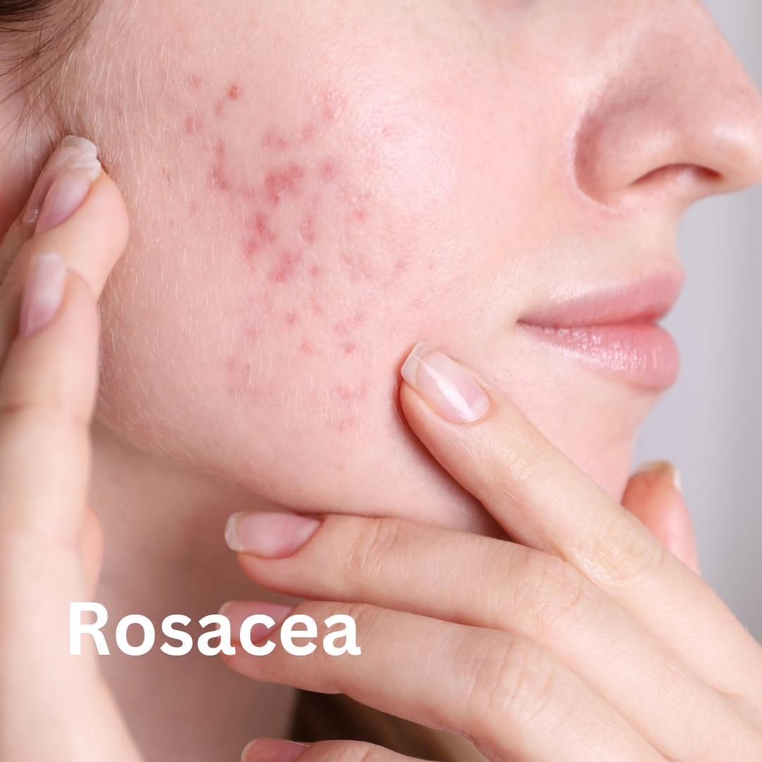 Rosacea