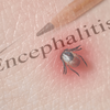 Tick Borne Encephalitis