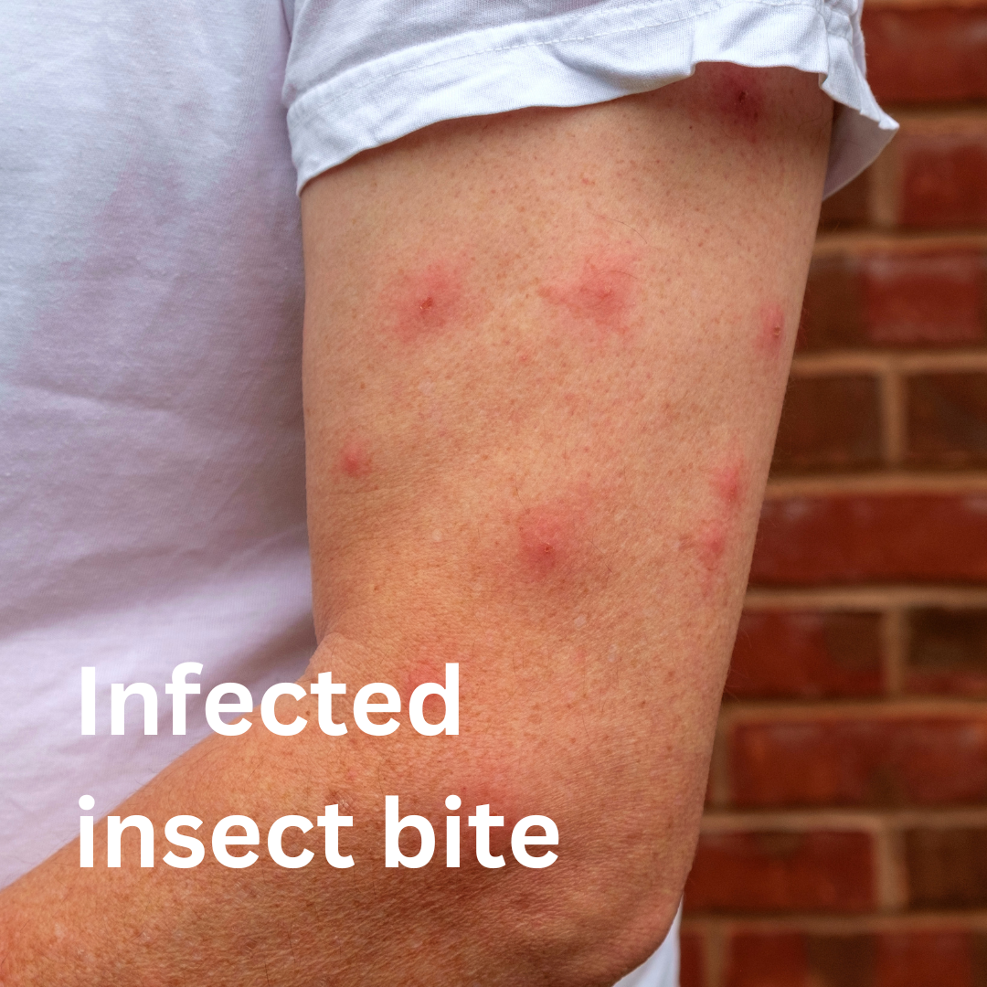 Infected Insect Bite - NHS Service