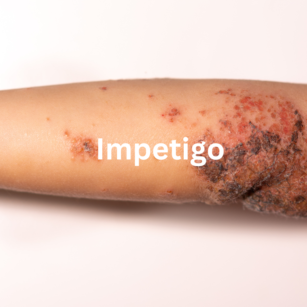 Impetigo - NHS Service