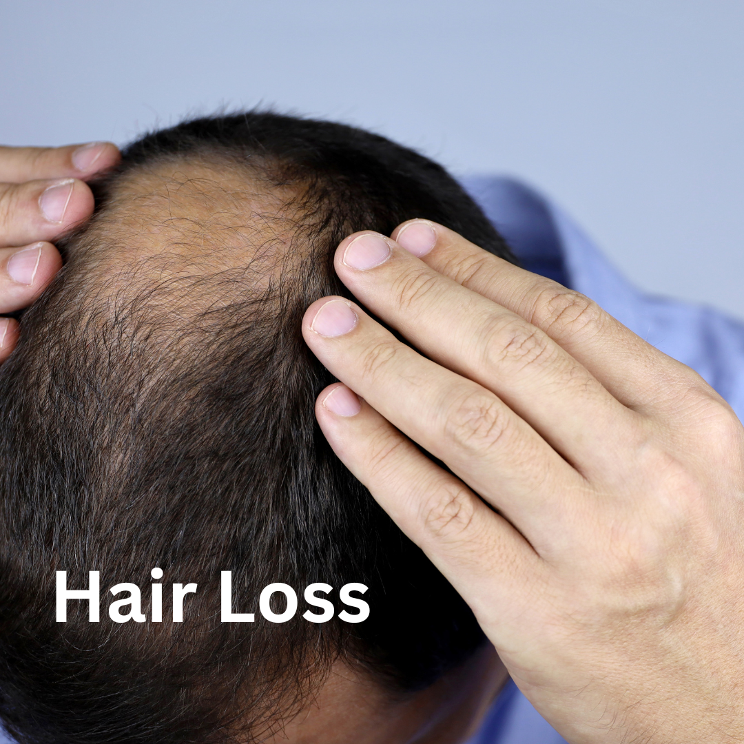 Hair-Loss