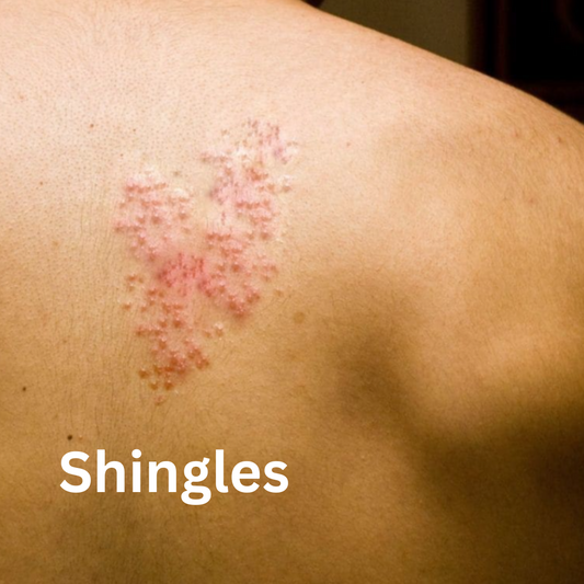 Shingles