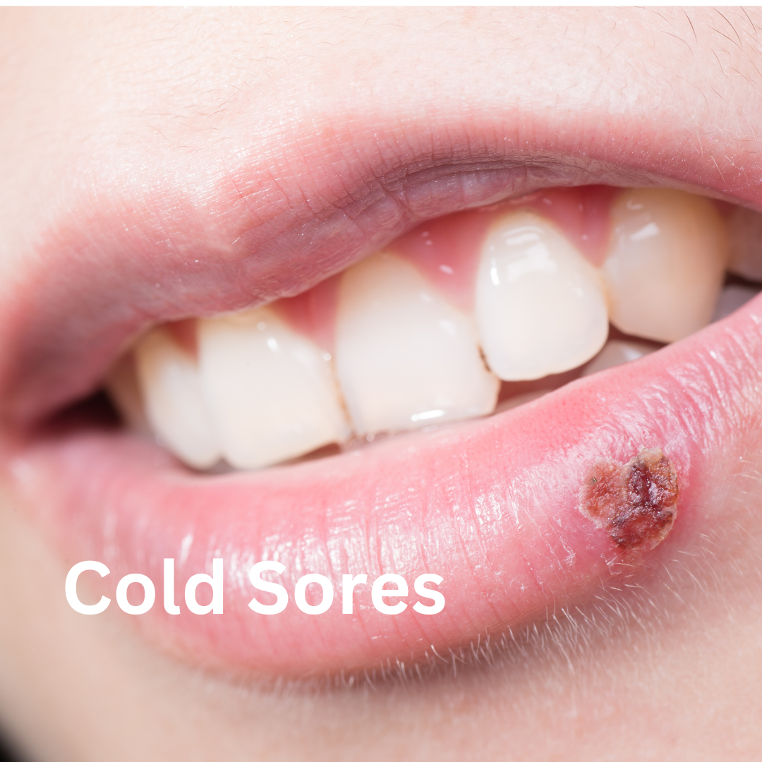 Cold Sore