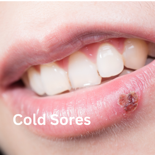 Cold Sore