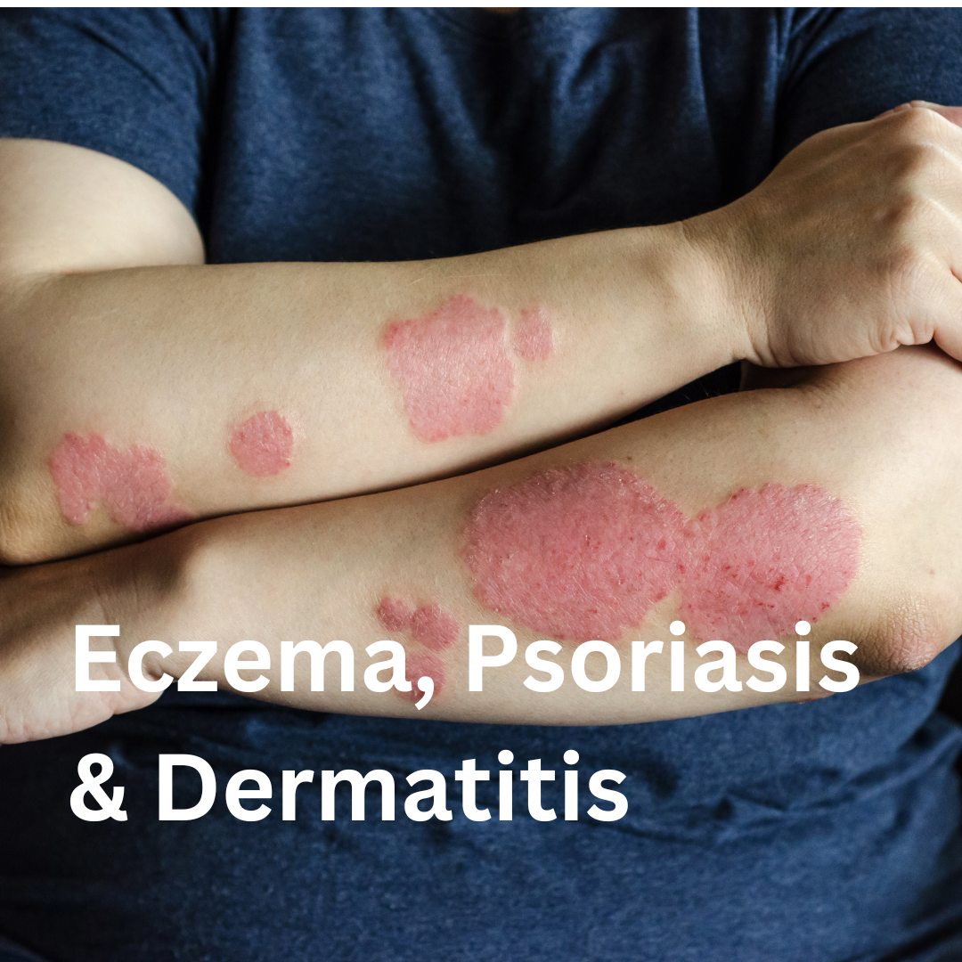 Eczema, Psoriasis & Dermatitis