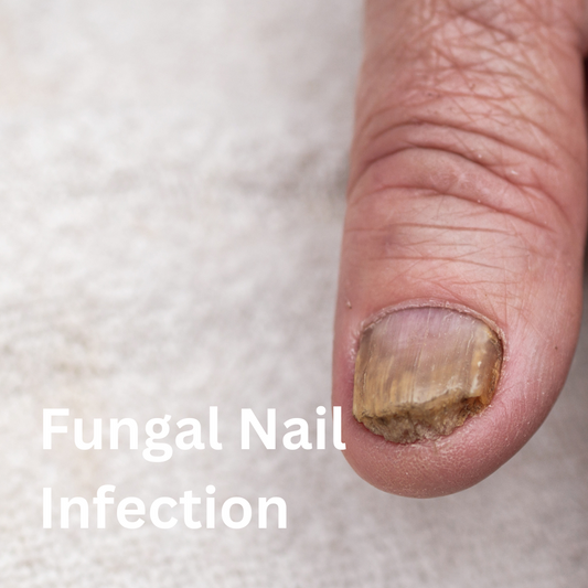 Fungal Nail Infection